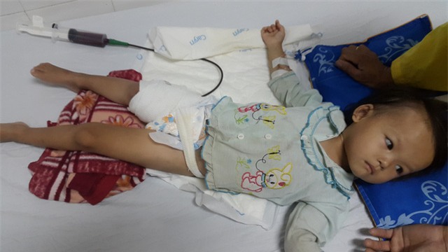 Xót lòng bé gái 3 tuổi suy dinh dưỡng có thể bị cắt cụt chân